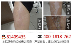 常规白癜风诊断有哪些误区