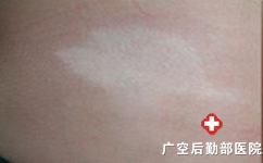 白癜风初期可以控制吗