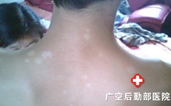 白癜风患者需不需要多锻炼