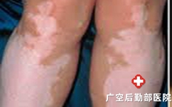 下肢白癜风为什么比较难治