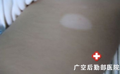 中药治疗白癜风的效果好不好